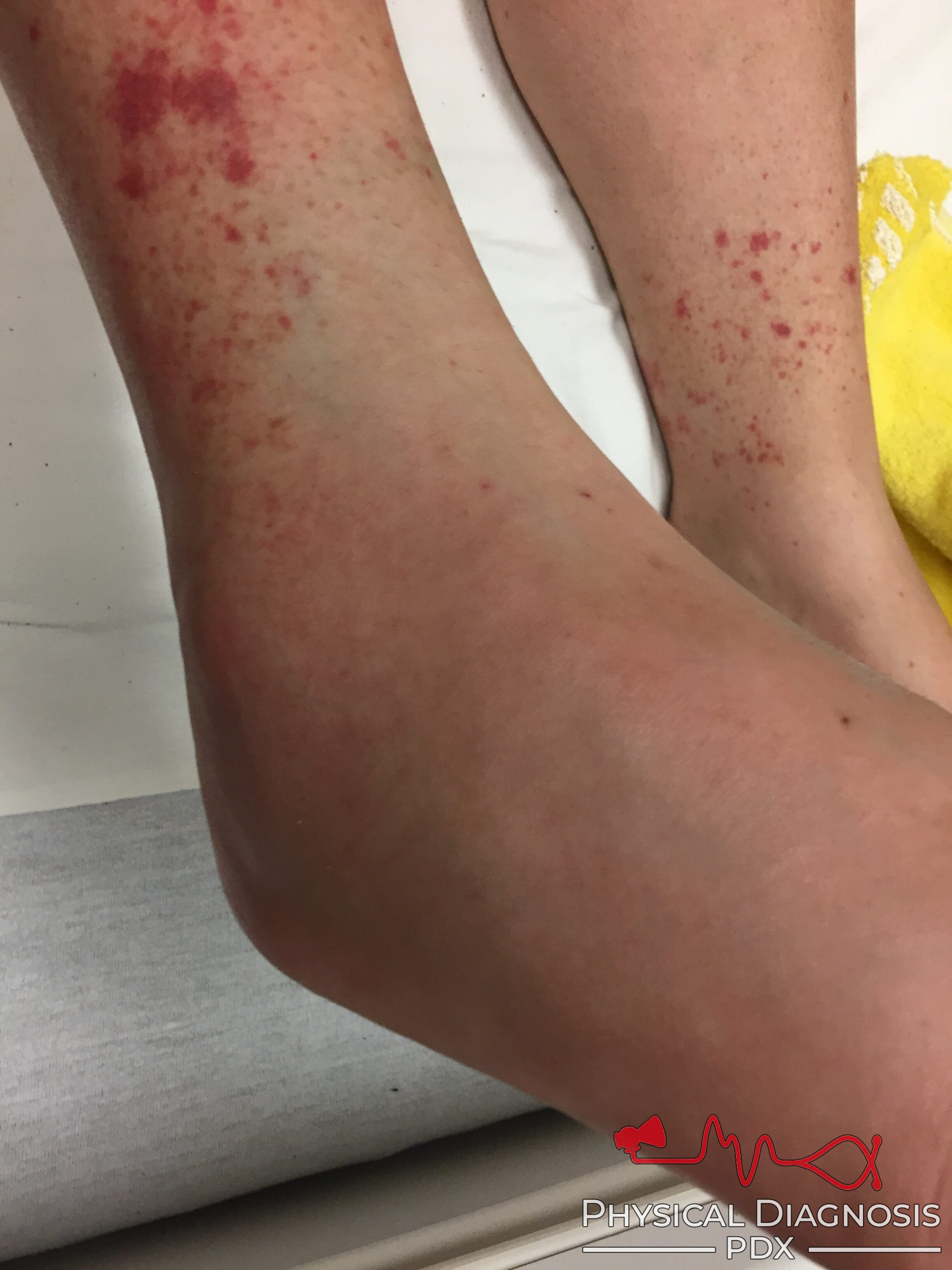 Petechial Rash Physical Diagnosis Pdx