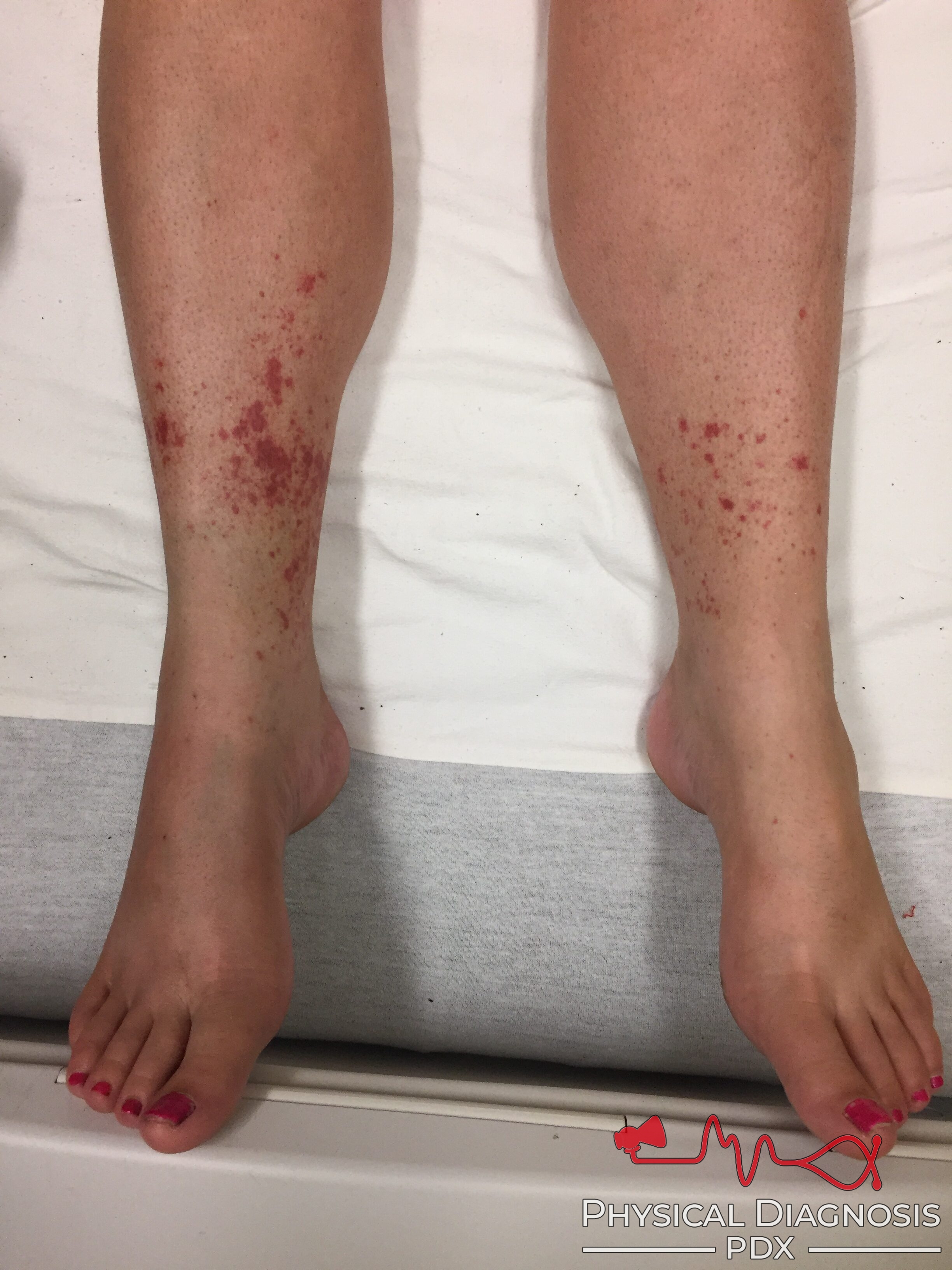 Petechiae On Legs