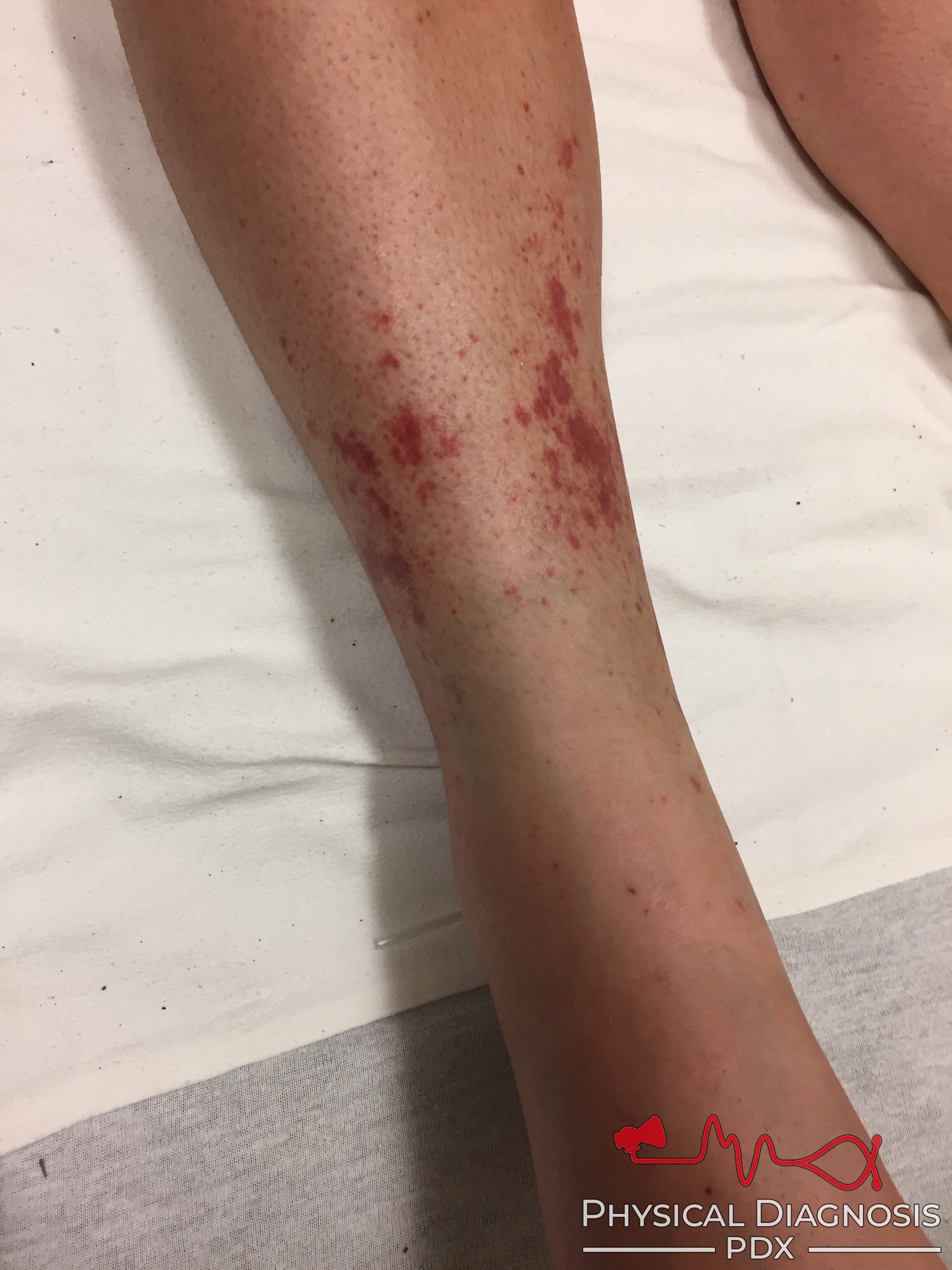 Petechial Rash - Physical Diagnosis PDX