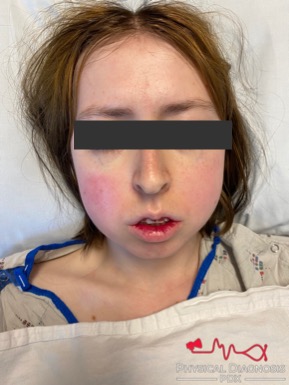 Malar Rash - Physical Diagnosis PDX