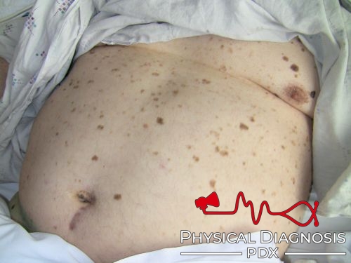 LeserTrelat sign Physical Diagnosis PDX