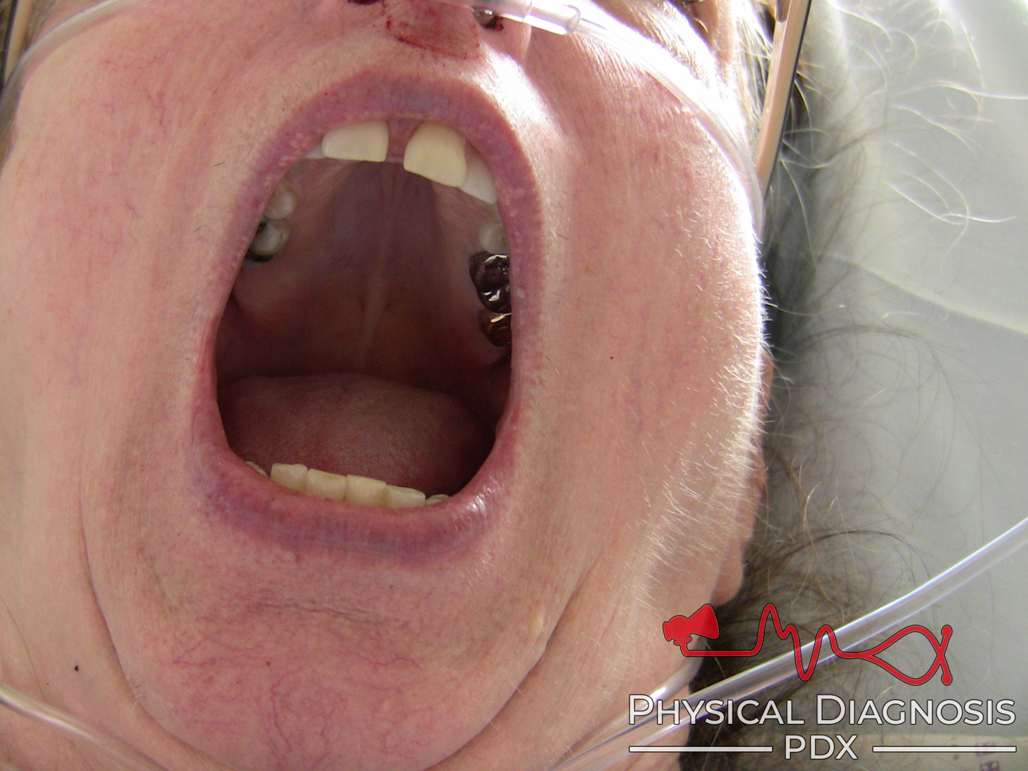 High Arched Palate Physical Diagnosis PDX